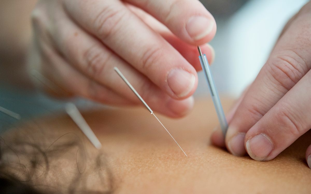 Pose de fines aiguilles d'acupuncture sur le dos, en gros plan